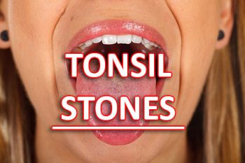 Albuquerque dentist, Dr. Shamaine Giron at ABQ Dentistry and Wellness tells patients about what causes tonsil stones and how to treat and prevent them from forming.