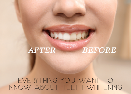 Everything You Want to Know About Teeth Whitening (featured image)
