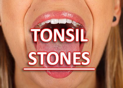 Suffering from a Sore Throat & Bad Breath? You Might Have Tonsil Stones (featured image)